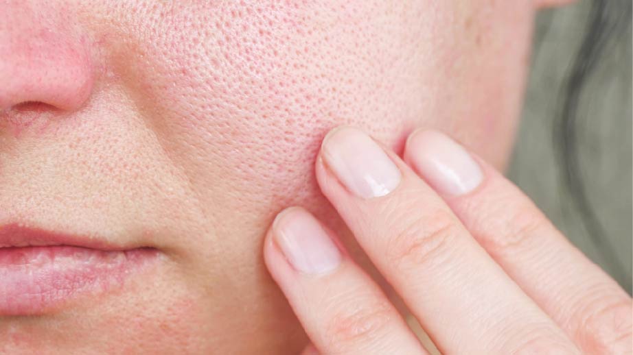 Skin Redness